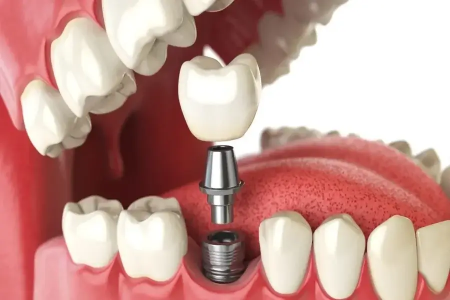 Considering Dental Implants In Mumbai? Here’s Why You’re Not Alone