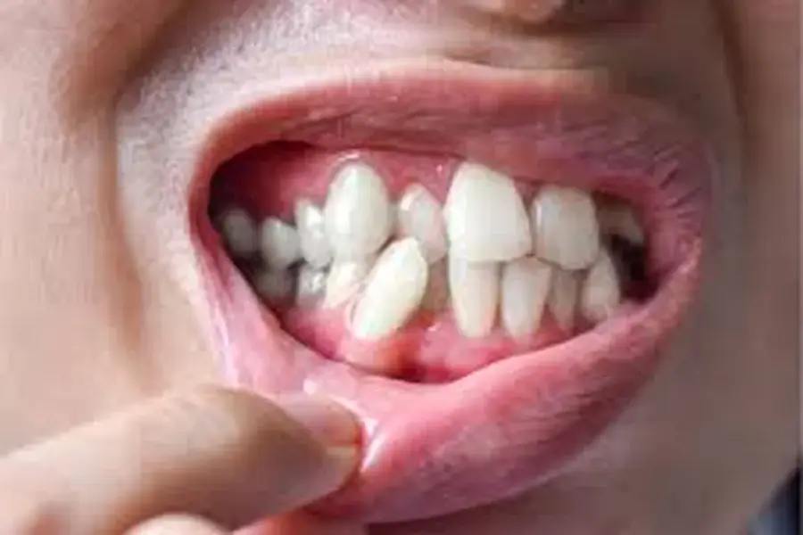 Tooth Loss
