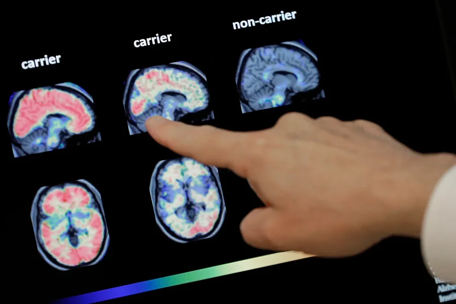 From Doubt To Data: The Clarity Offered By An Alzheimer’s Brain Scan