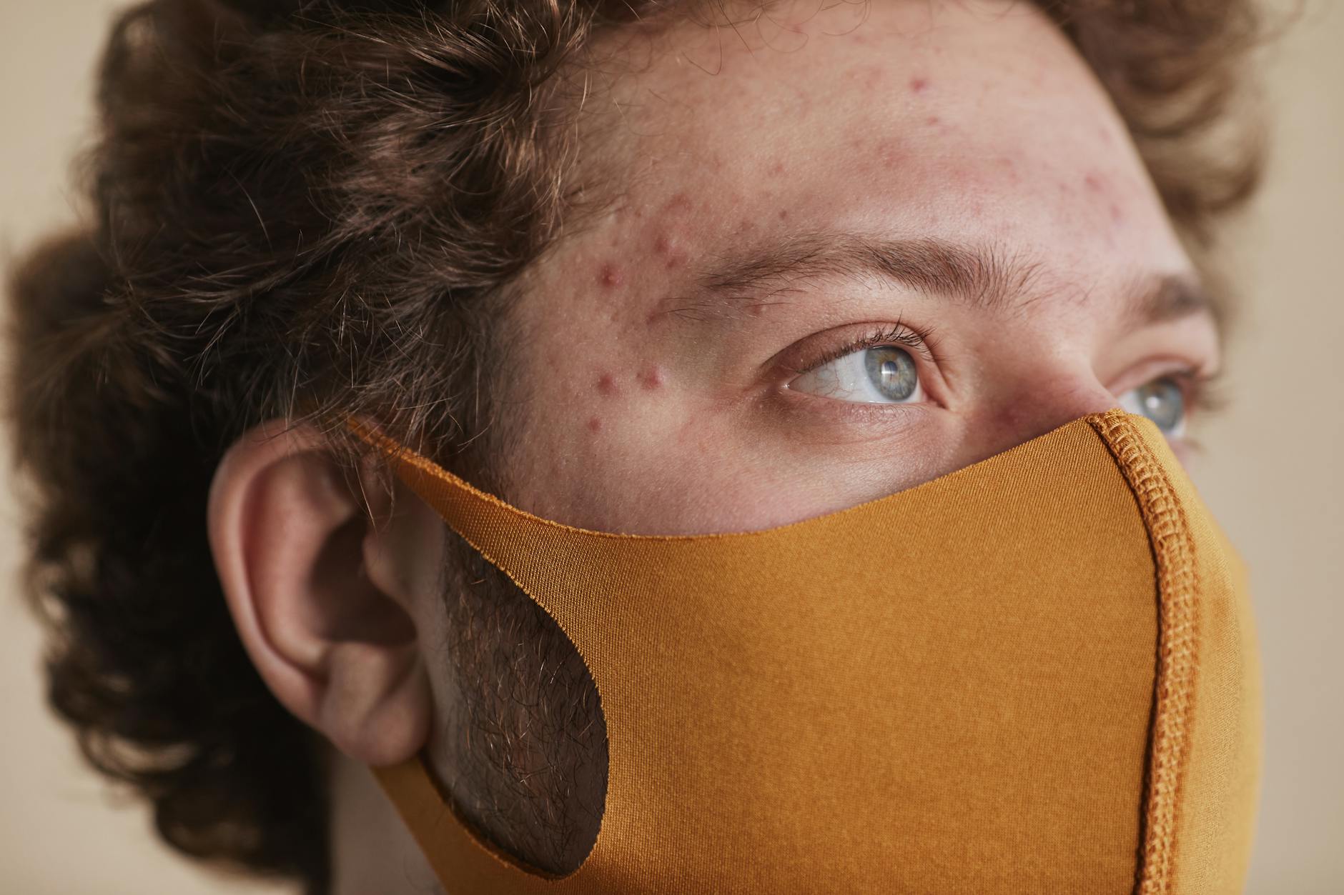Why Post-Acne Pigmentation Happens